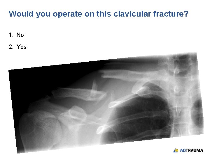 Would you operate on this clavicular fracture? 1. No 2. Yes 