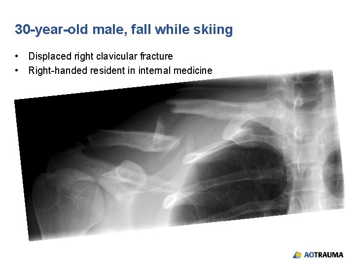 30 -year-old male, fall while skiing • Displaced right clavicular fracture • Right-handed resident