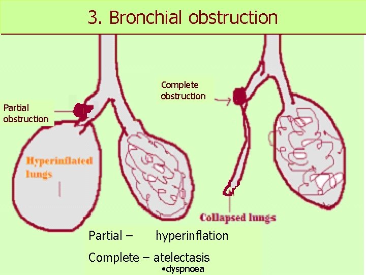 Bronchial 3. Bronchialobstruction Complete obstruction Partial – hyperinflation Complete – atelectasis • dyspnoea 