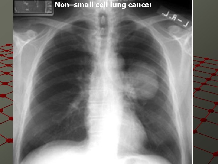 Non–small cell lung cancer 