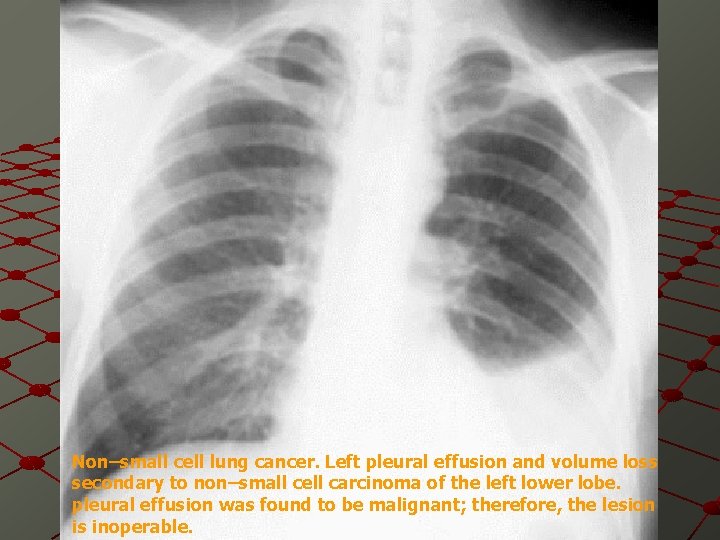Non–small cell lung cancer. Left pleural effusion and volume loss secondary to non–small cell