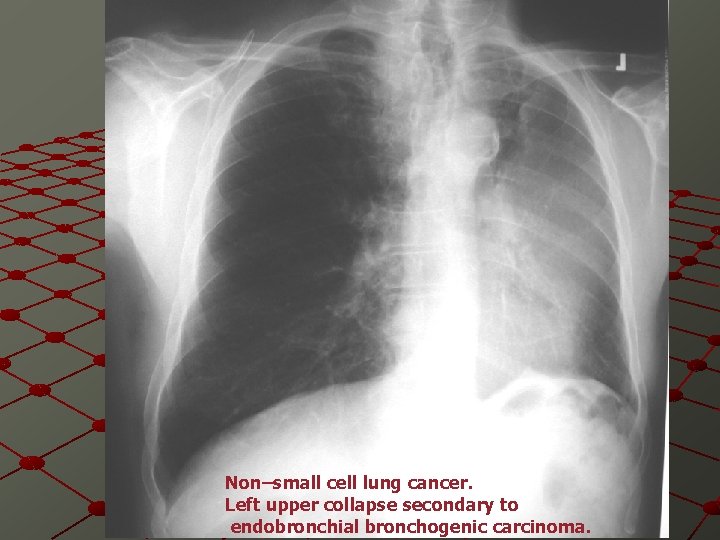 Non–small cell lung cancer. Left upper collapse secondary to endobronchial bronchogenic carcinoma. 