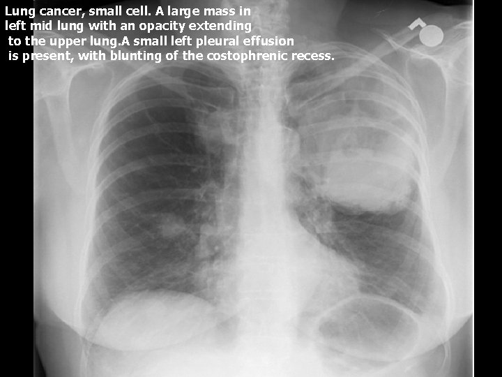 Lung cancer, small cell. A large mass in left mid lung with an opacity