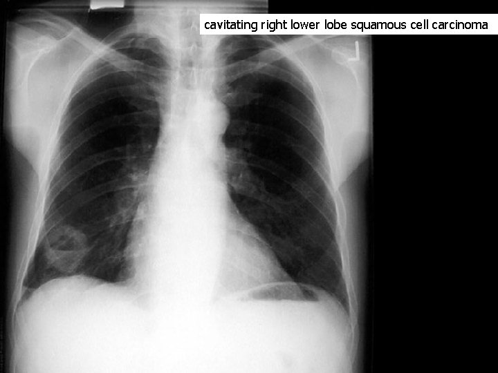 cavitating right lower lobe squamous cell carcinoma 