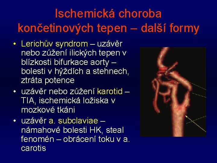 Ischemická choroba končetinových tepen – další formy • Lerichův syndrom – uzávěr nebo zúžení