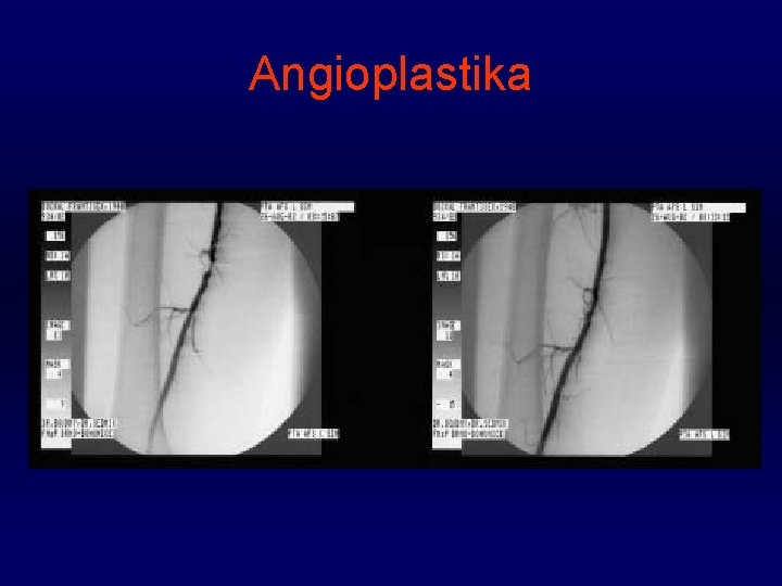 Angioplastika 