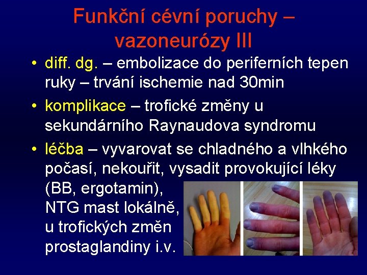 Funkční cévní poruchy – vazoneurózy III • diff. dg. – embolizace do periferních tepen