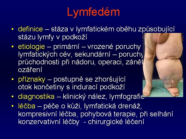 Lymfedém • definice – stáza v lymfatickém oběhu způsobující stázu lymfy v podkoží •