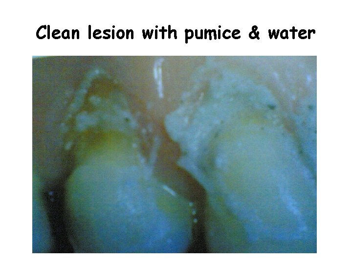 Clean lesion with pumice & water 