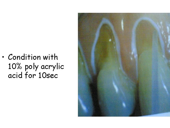  • Condition with 10% poly acrylic acid for 10 sec 