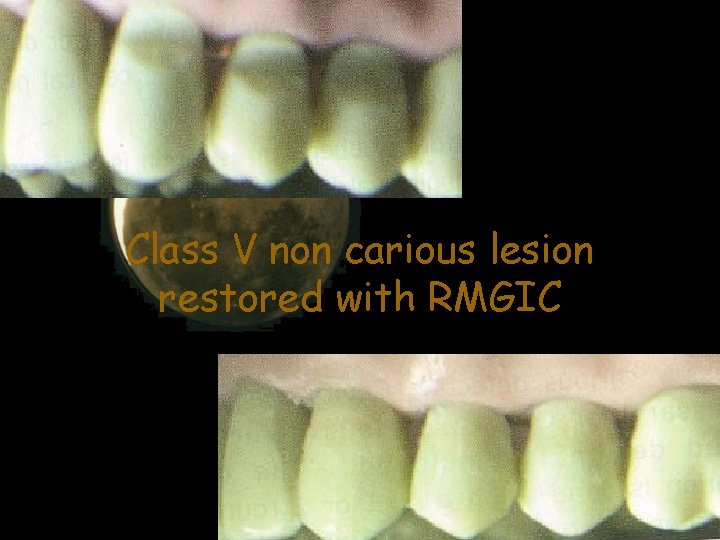 Class V non carious lesion restored with RMGIC 