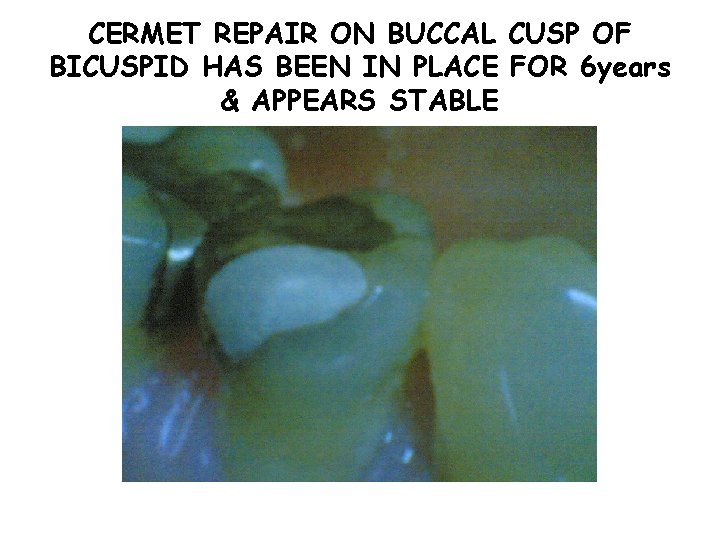 CERMET REPAIR ON BUCCAL CUSP OF BICUSPID HAS BEEN IN PLACE FOR 6 years