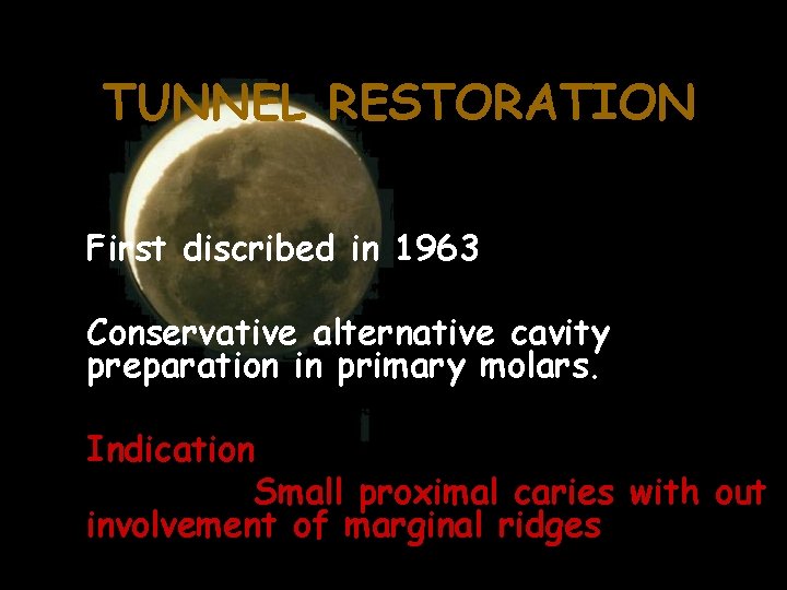 TUNNEL RESTORATION First discribed in 1963 Conservative alternative cavity preparation in primary molars. Indication