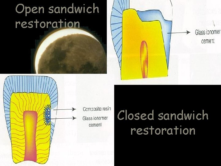 Open sandwich restoration Closed sandwich restoration 