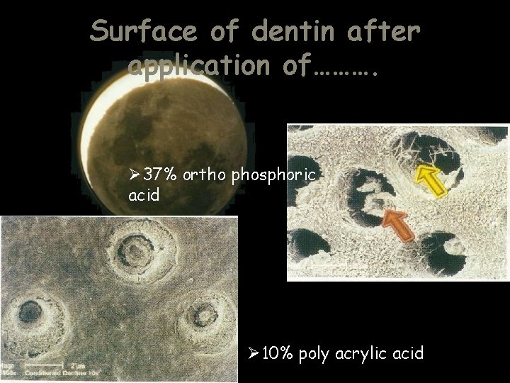 Surface of dentin after application of………. Ø 37% ortho phosphoric acid Ø 10% poly