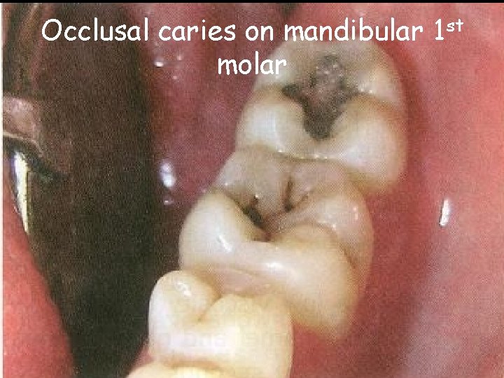 Occlusal caries on mandibular 1 st molar Occlusal caries on mandibular 1 st molar