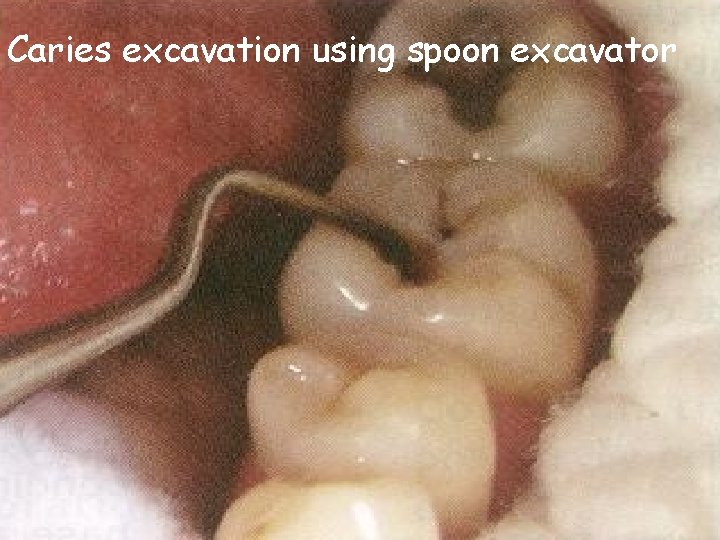 Caries excavation using spoon excavator Caries excavation using spoon excavator