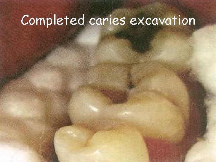 Completed caries excavation Completed caries excavation
