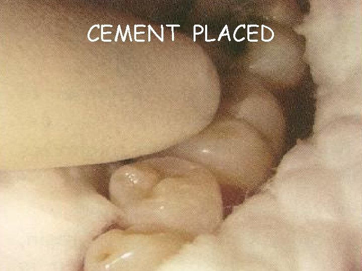 CEMENT PLACED 