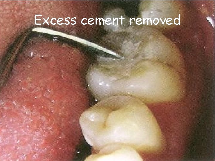 Excess cement removed 