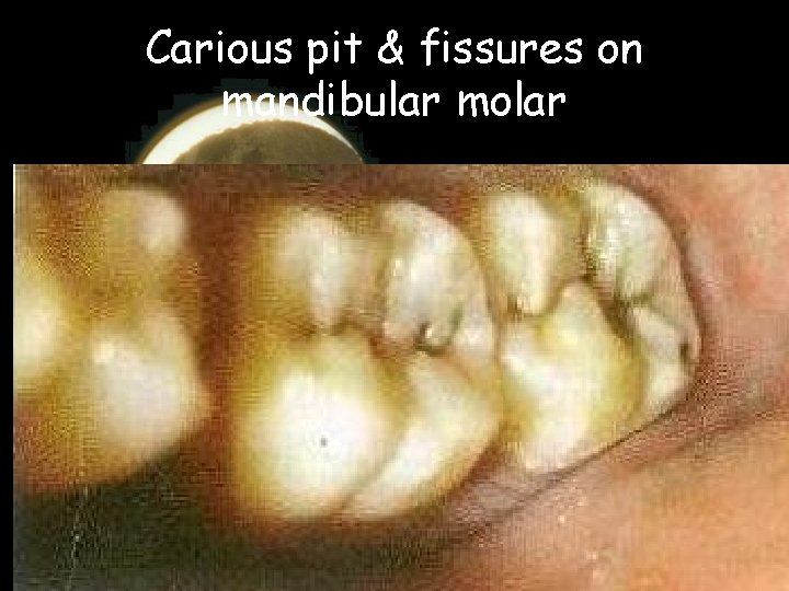 Carious pit & fissures on mandibular molar 