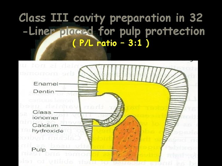 Class III cavity preparation in 32 -Liner placed for pulp prottection ( P/L ratio