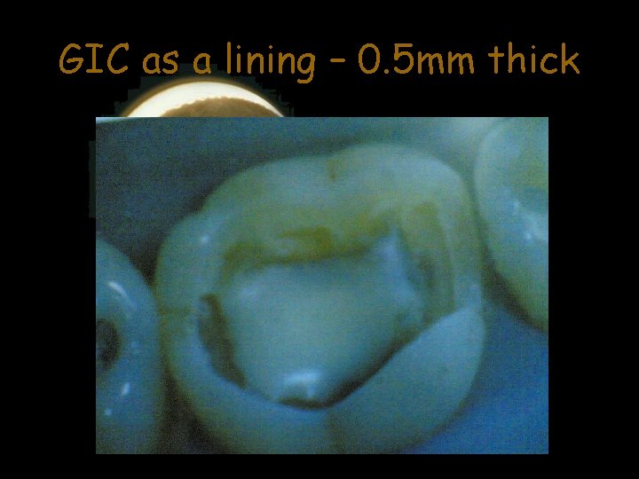 GIC as a lining – 0. 5 mm thick 