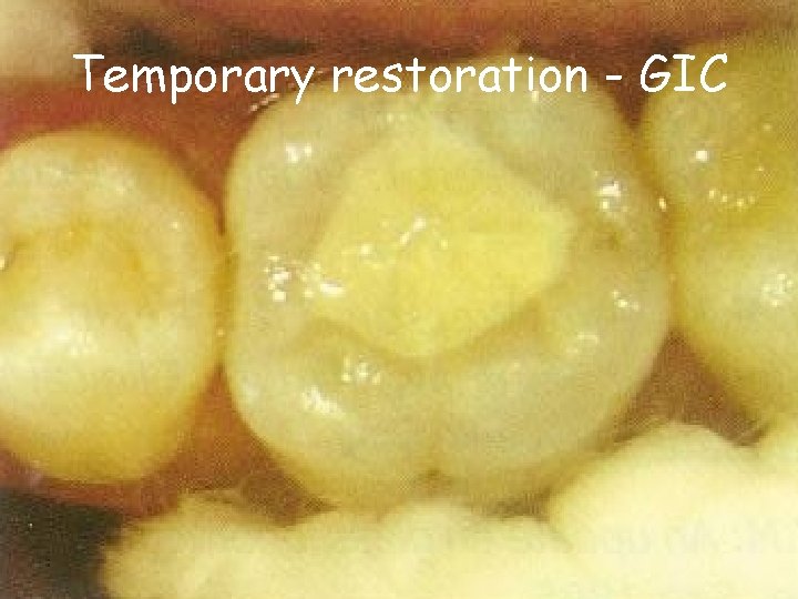 Temporary restoration - GIC 