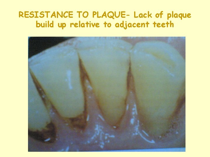 RESISTANCE TO PLAQUE- Lack of plaque build up relative to adjacent teeth RESISTANCE TO PLAQUE- Lack of plaque build up relative to adjacent teeth