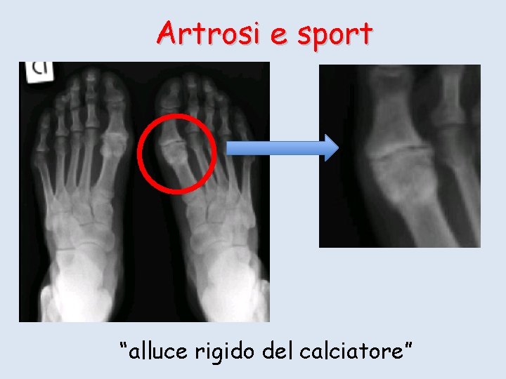 Artrosi e sport “alluce rigido del calciatore” 