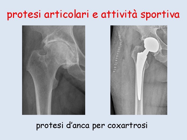 protesi articolari e attività sportiva protesi d’anca per coxartrosi 