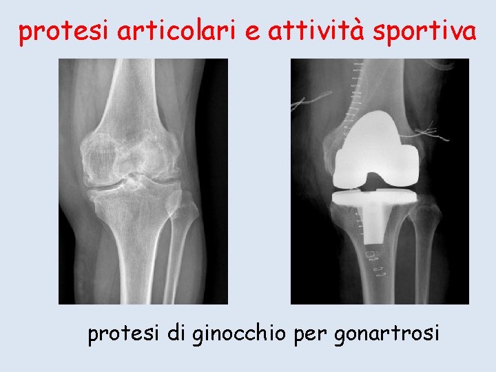 protesi articolari e attività sportiva protesi di ginocchio per gonartrosi 
