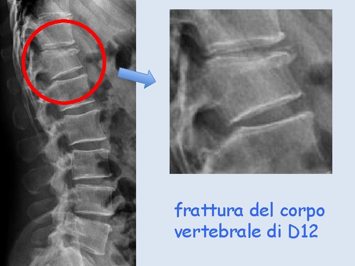 frattura del corpo vertebrale di D 12 