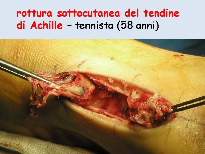 rottura sottocutanea del tendine di Achille – tennista (58 anni) 