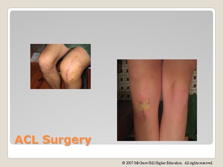 ACL Surgery © 2007 Mc. Graw-Hill Higher Education. All rights reserved. 