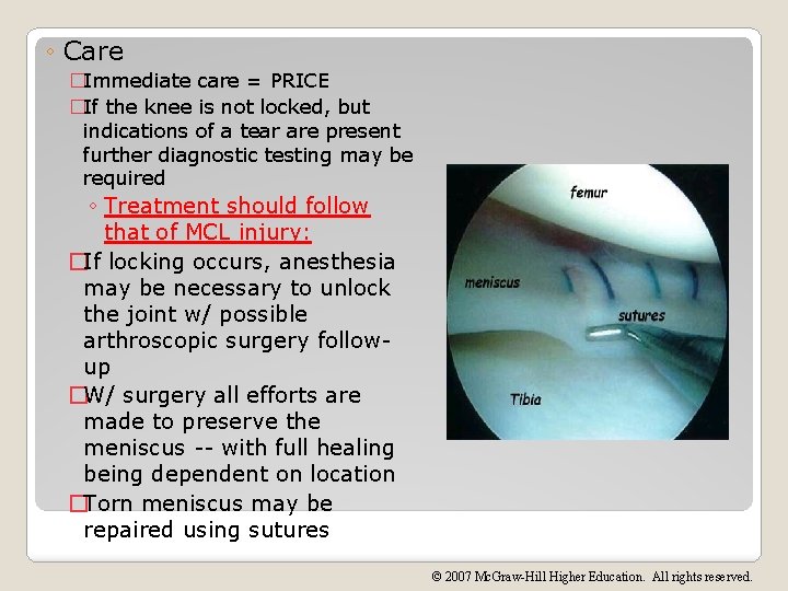 ◦ Care �Immediate care = PRICE �If the knee is not locked, but indications
