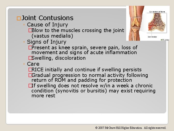 �Joint Contusions ◦ Cause of Injury �Blow to the muscles crossing the joint (vastus