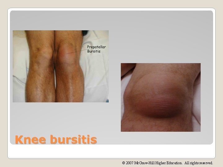 Knee bursitis © 2007 Mc. Graw-Hill Higher Education. All rights reserved. 