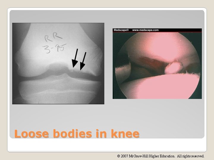 Loose bodies in knee © 2007 Mc. Graw-Hill Higher Education. All rights reserved. 
