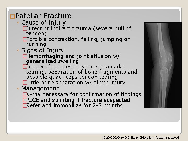 �Patellar Fracture ◦ Cause of Injury �Direct or indirect trauma (severe pull of tendon)