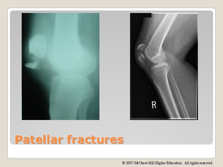 Patellar fractures © 2007 Mc. Graw-Hill Higher Education. All rights reserved. 