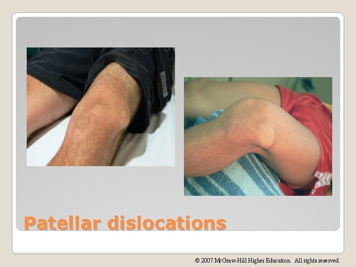 Patellar dislocations © 2007 Mc. Graw-Hill Higher Education. All rights reserved. 