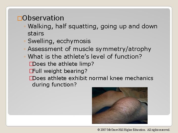 �Observation ◦ Walking, half squatting, going up and down stairs ◦ Swelling, ecchymosis ◦