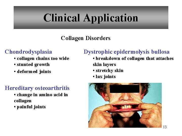 Clinical Application Collagen Disorders Chondrodysplasia • collagen chains too wide • stunted growth •