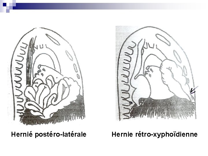 Hernié postéro-latérale Hernie rétro-xyphoïdienne 