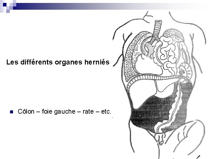 Les différents organes herniés n Côlon – foie gauche – rate – etc. 