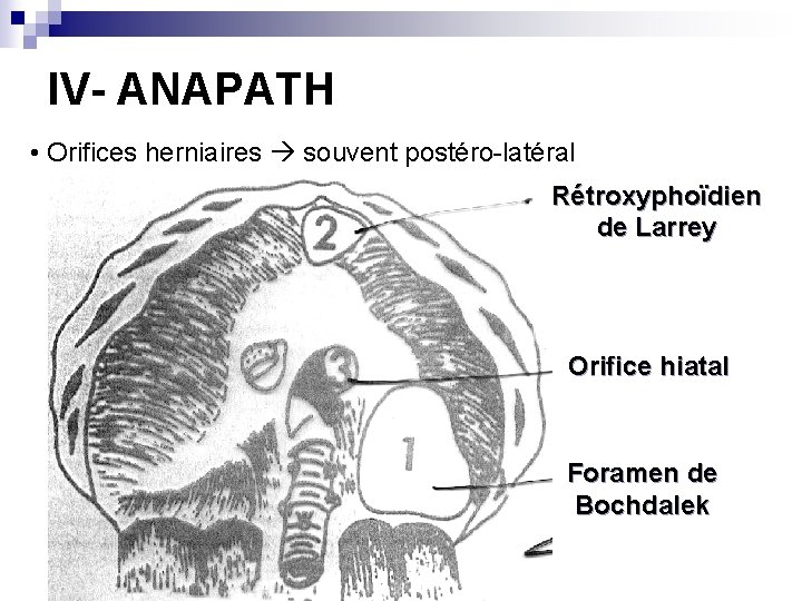 IV- ANAPATH • Orifices herniaires souvent postéro-latéral Rétroxyphoïdien de Larrey Orifice hiatal Foramen de