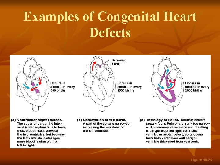 Examples of Congenital Heart Defects Figure 18. 25 