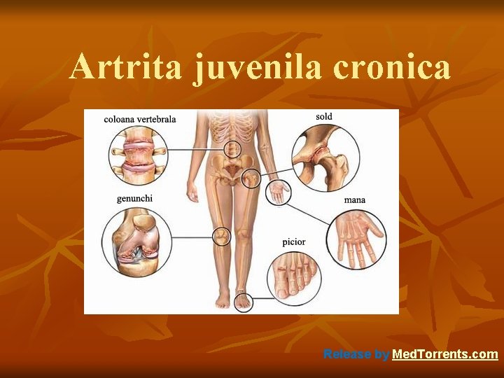 Artrita juvenila cronica Release by Med. Torrents. com 
