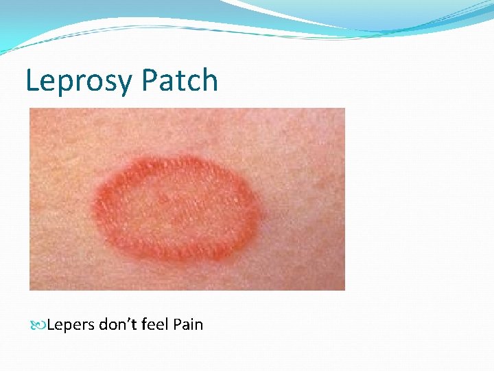 Leprosy Patch Lepers don’t feel Pain 